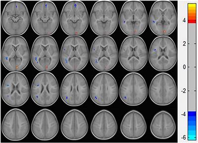 Alterations of Regional Homogeneity in Preschool Boys With Autism Spectrum Disorders